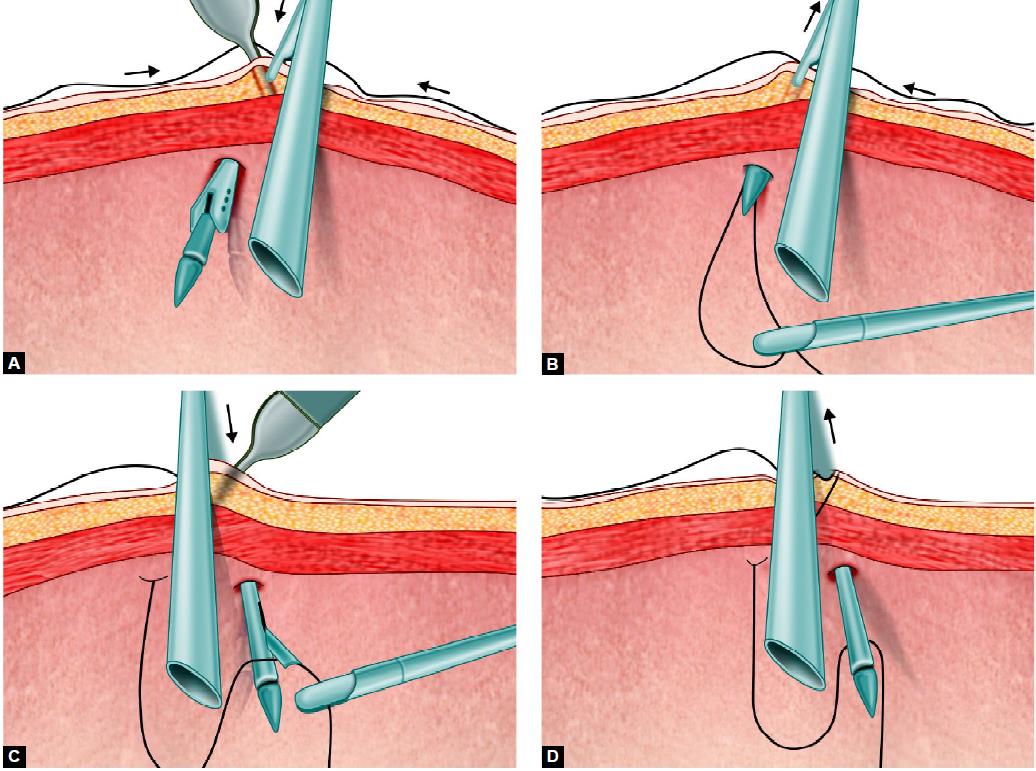 Port closure with the help of suture passer