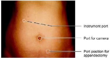 Port position for appendectomy
