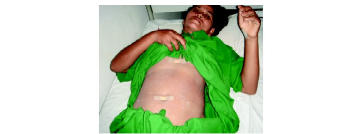 Port position for two-port cholecystectomy