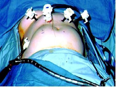 Port position in hiatus hernia