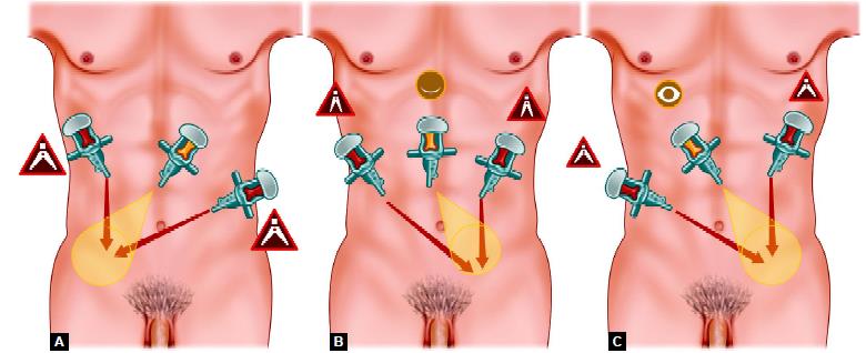 (A) Port position of right sided hernia; (B) Port position of bilateral hernia; (C) Port position of left sided hernia