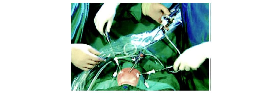 Port position for pediatric appendicectomy