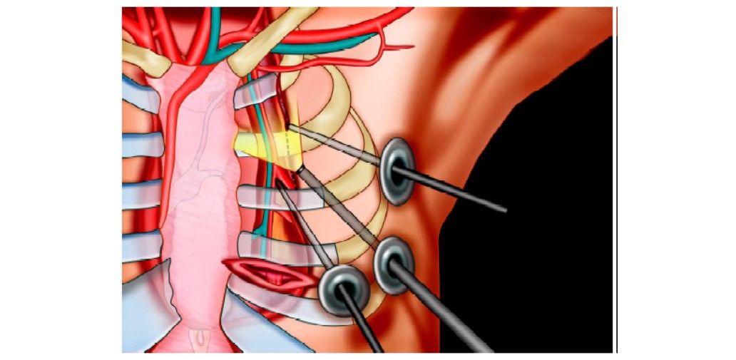 Ports in cardiac minimal access surgery