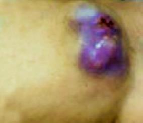 Portside metastasis after laparoscopic surgery