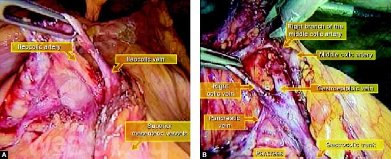 (A) Position of major blood vessels at the time of surgery; (B) Important vessels supplying right side of the colon