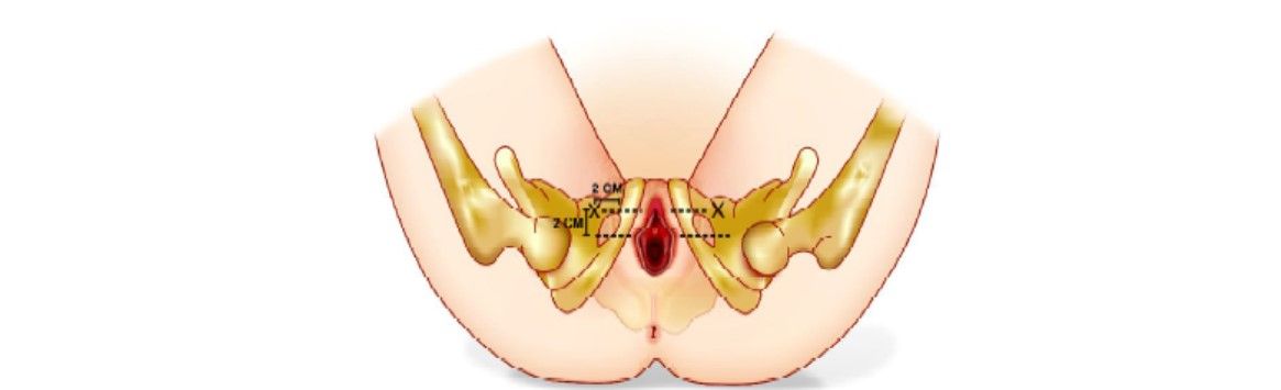 Position the patient, mark thigh exit point and make vaginal midline incision