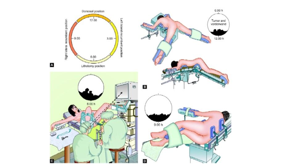 Positioning of patient for TEM