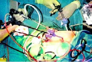 Port position in fundoplication