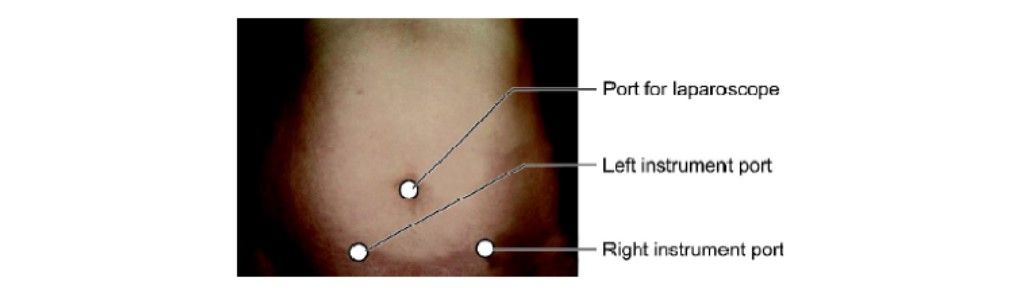 Port position for LAVH