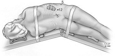 Patient position in Retroperitoneoscopy 