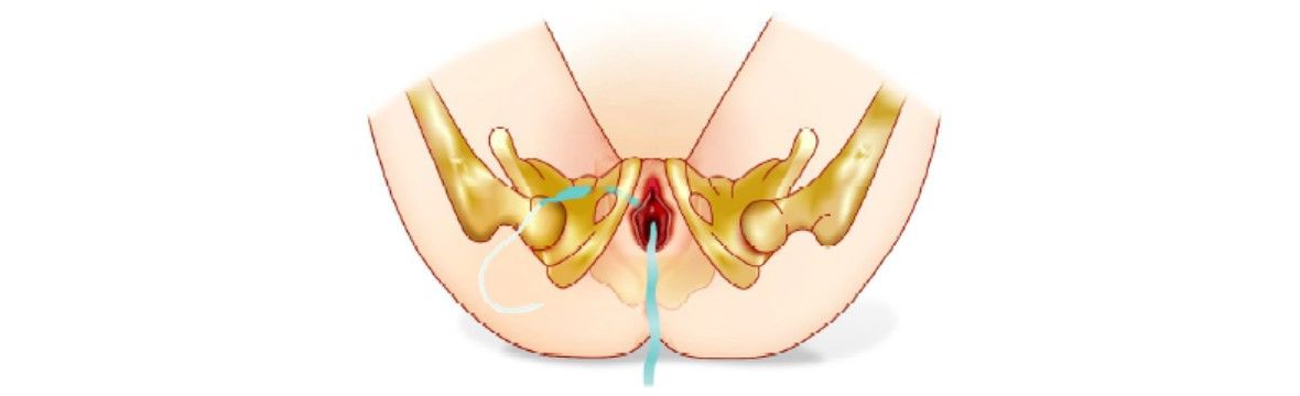 Pull plastic tube and tape completely through the skin