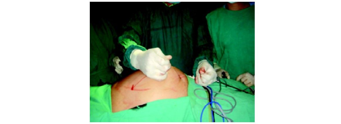 Each pair of the suture is pulled out through the same skin incision but different rectus and muscle layer