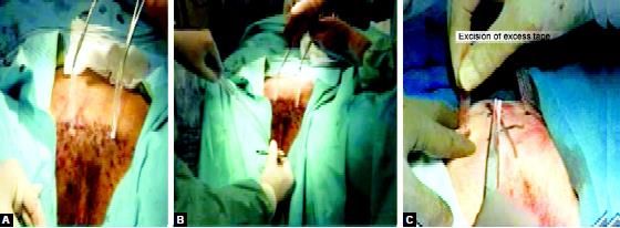 Removal of plastic tape with cutting the excessive mesh