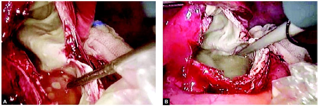 Removal of cyst with the help of endobag
