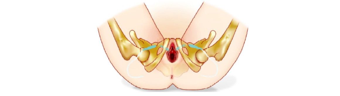 Steps of introduction of mesh should be repeated on patient's other side