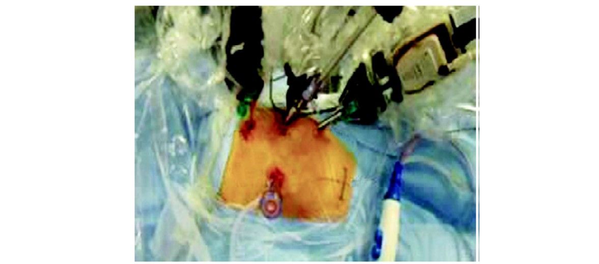 Robotic surgery port placement for nephrectomy