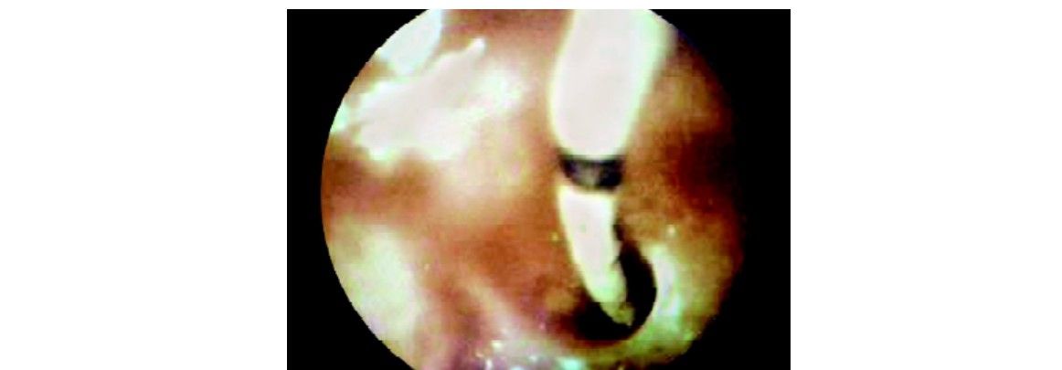Salpingo-catheterization