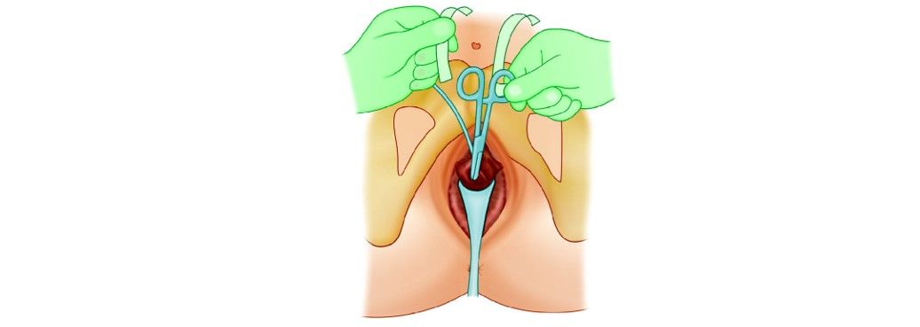 Scissors or forceps should be placed between the urethra and the tape