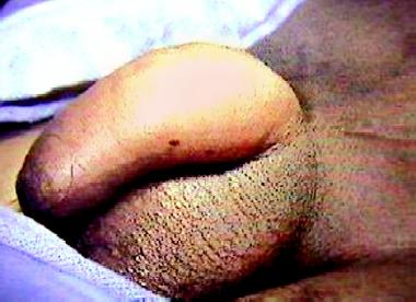 Postoperative scrotal hematoma