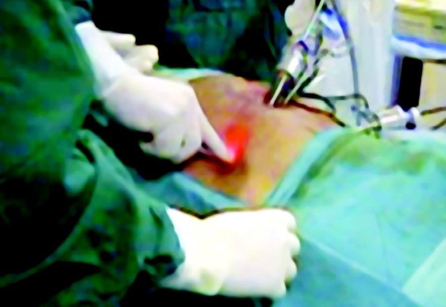 Introduction of secondary port