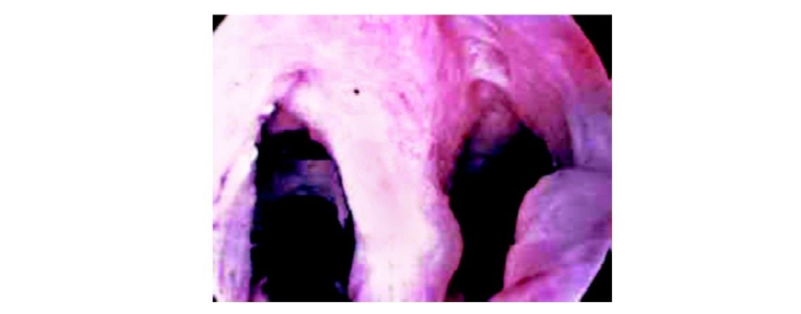 Septate uterus