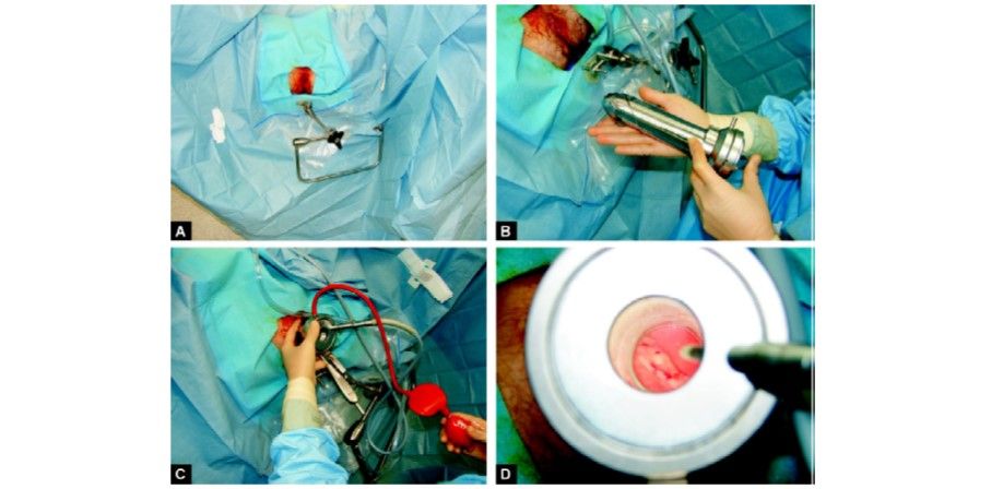 Setting us instruments in TEM 