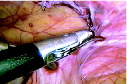 Sharp dissection with scissors if bowel is involved