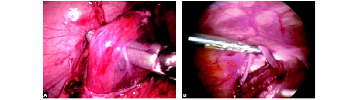 The spermatic vein is identified