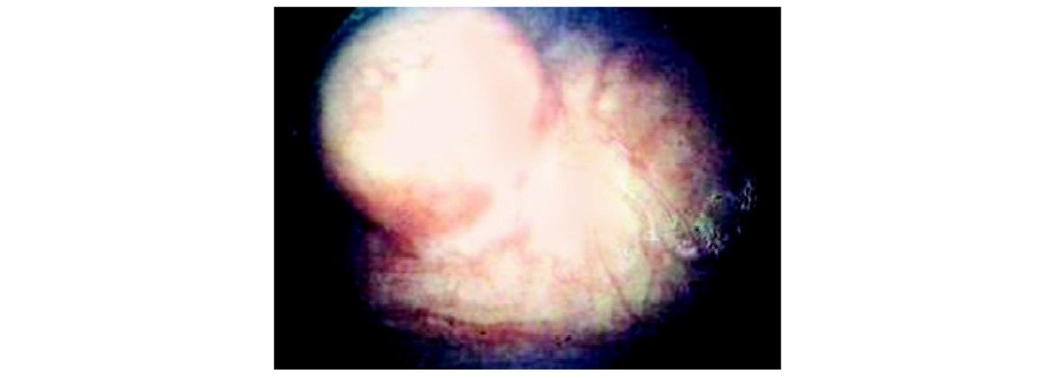 Submucous myoma