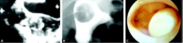 Submucous myoma