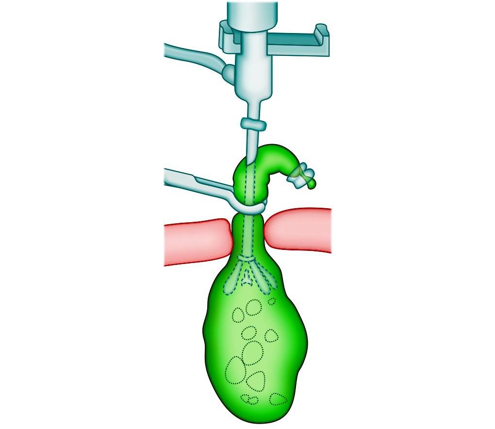 Suction of bile to extract gallbladder