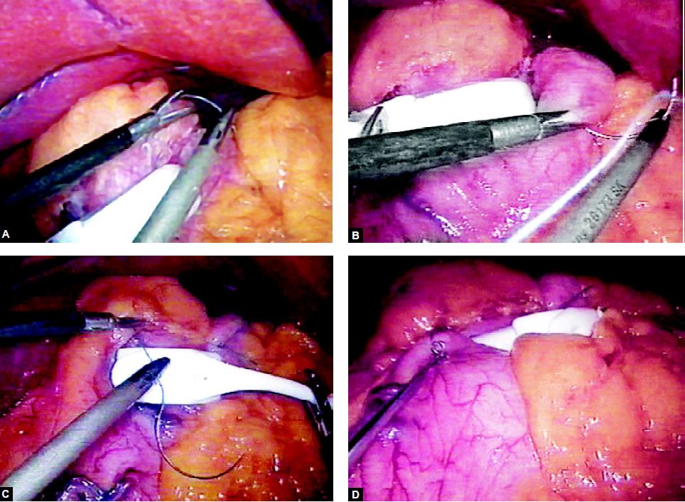 Suture is placed to fix the band in position