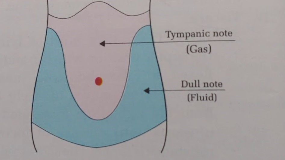 Tapping over right hypochondrium will demonstrate obliteration of liver dullness