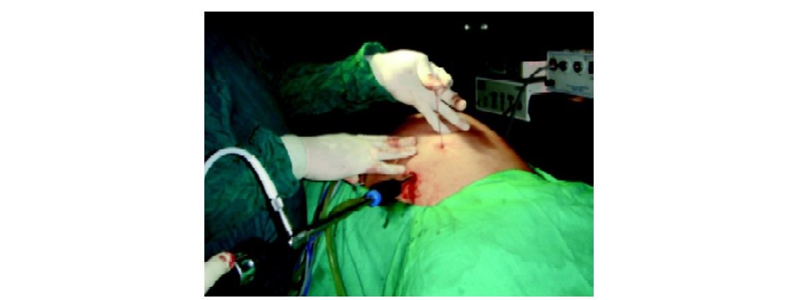 Both end of suture is tied outside the skin. Skin is lifted to slip the knot subcutaneously