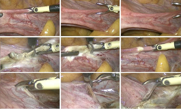 Total Laparoscopic Hysterectomy
