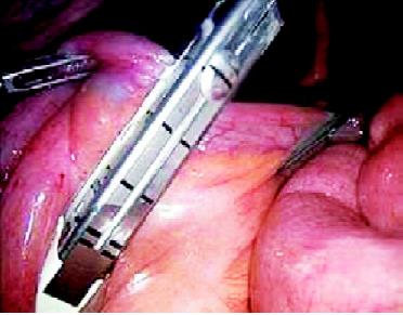 Transaction of ileum by stapler