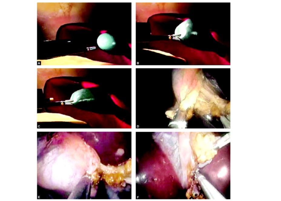 Transvaginal cholecystectomy