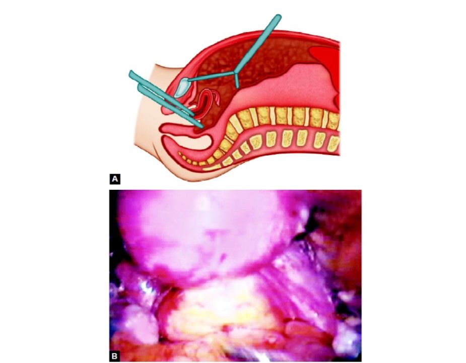 Transvaginal route of insufflation