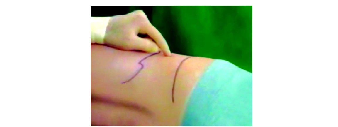 Place for primary trocar insertion in retroperitoneoscopy