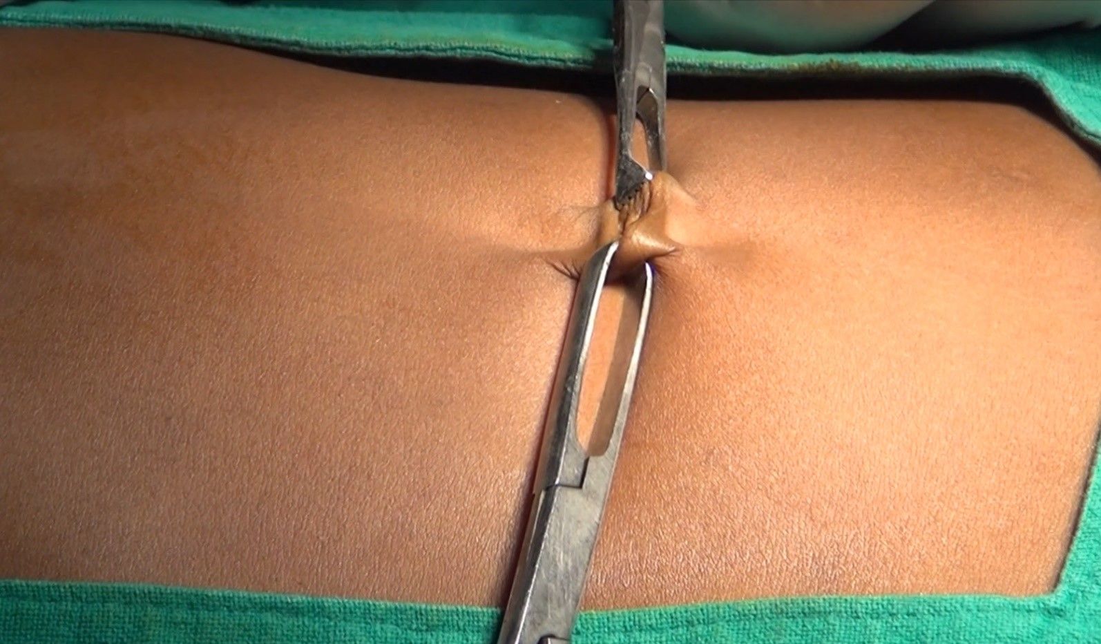 Two-Ellis Forceps is applied over the crease of umbilicus  