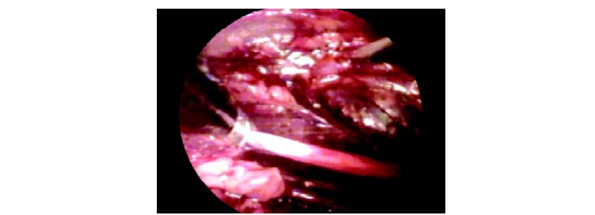 Ureter as seen during retroperitoneoscopy