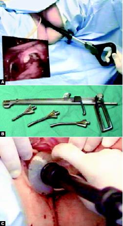 Uterine Manipulator