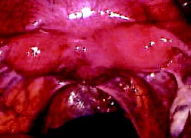 Bicornuate uterus