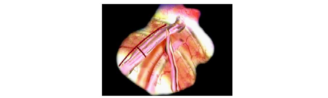 Laparoscopic varicocelectomy