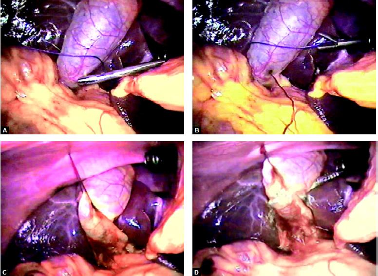 Another Vicryl is applied over Hartsman pouch to provide anterolateral traction. Any leak from the gallbladder is irrigated and sucked nicely with the help of suction irrigation instrument