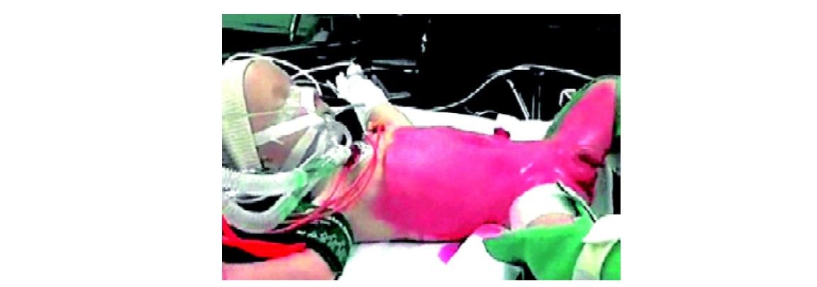 All the vital parameter should be strictly monitored in pediatric age group