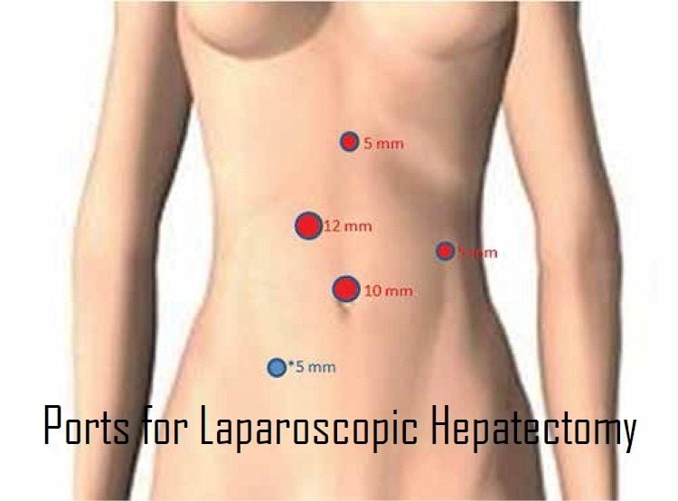 Port Position of Various Laparoscopic General Surgeries