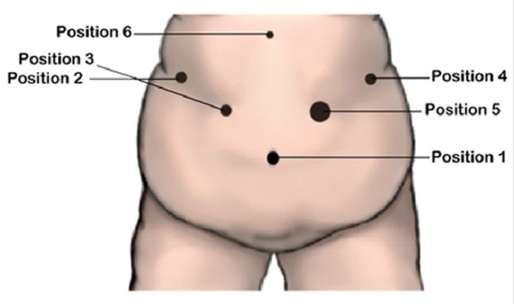 Port Position of Various Laparoscopic General Surgeries