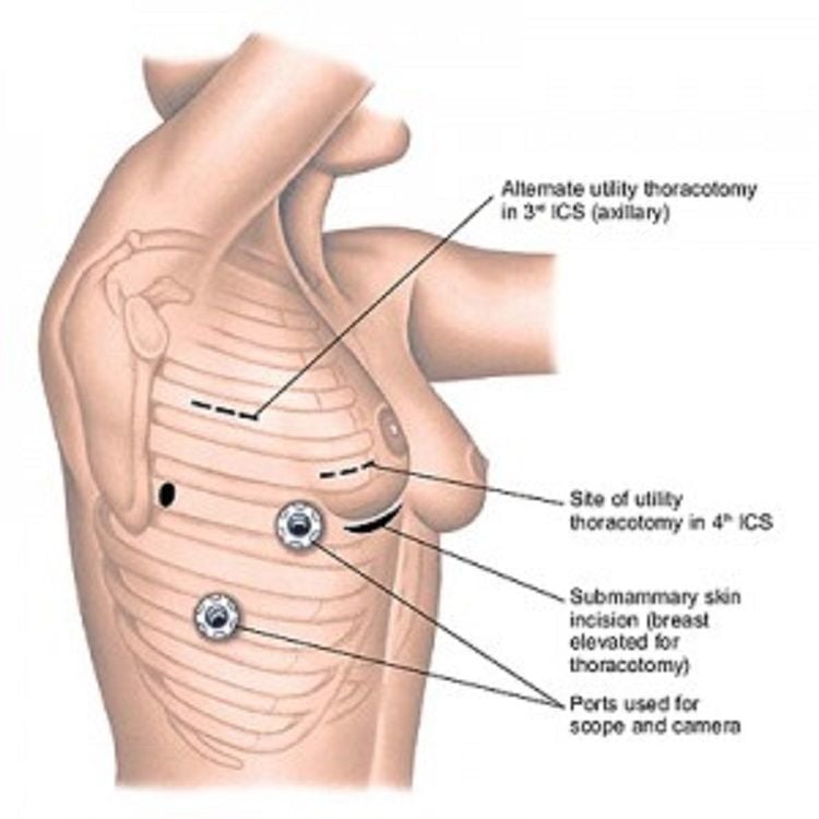 Port Position of Various Thoracoscopic Surgeries