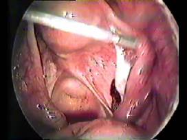 Salpingotomy for unruptured Ectopic pregnancy